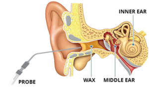 microsuction and view of inner ear